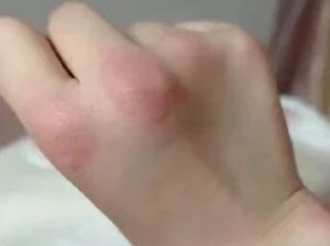 “阳了”后如果身上出现这种情况，赶紧去医院！