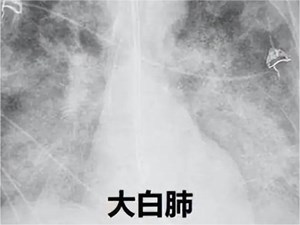 专家提醒！3个方法可提前预警“白肺”，这几类人是高风险......